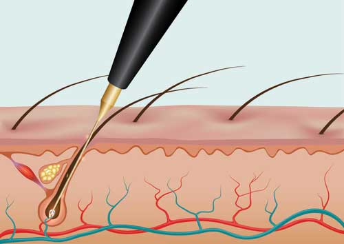 در از بین بردن موهای زائد با روش الکترولیز، پروب سوزنی بسیار ریز را از طریق منافذ وارد می کند، سپس با استفاده از الکتریسیته و ایجاد موج الکتریکی کوتاه فولیکول مو را از بین می‌برند.
